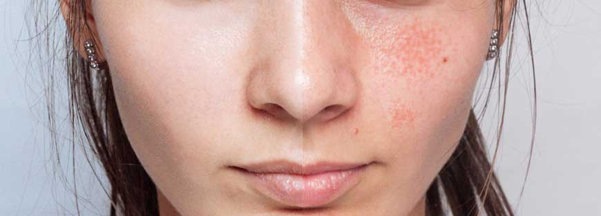 楊浩康(Yeung Ho Hong)醫生講解肝斑 / 賀爾蒙斑 (Melasma)